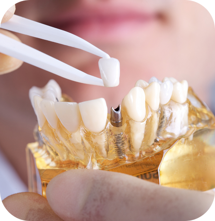 Implantologia dentale | Dentista Santarcangelo - Omnia