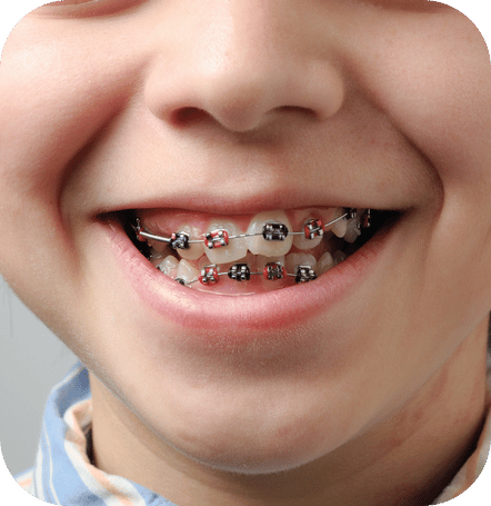 Ortodonzia denti storti | Dentista Santarcangelo - Omnia