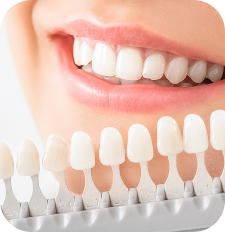 Sbiancamento denti Santarcangelo | Studio dentistico Omnia