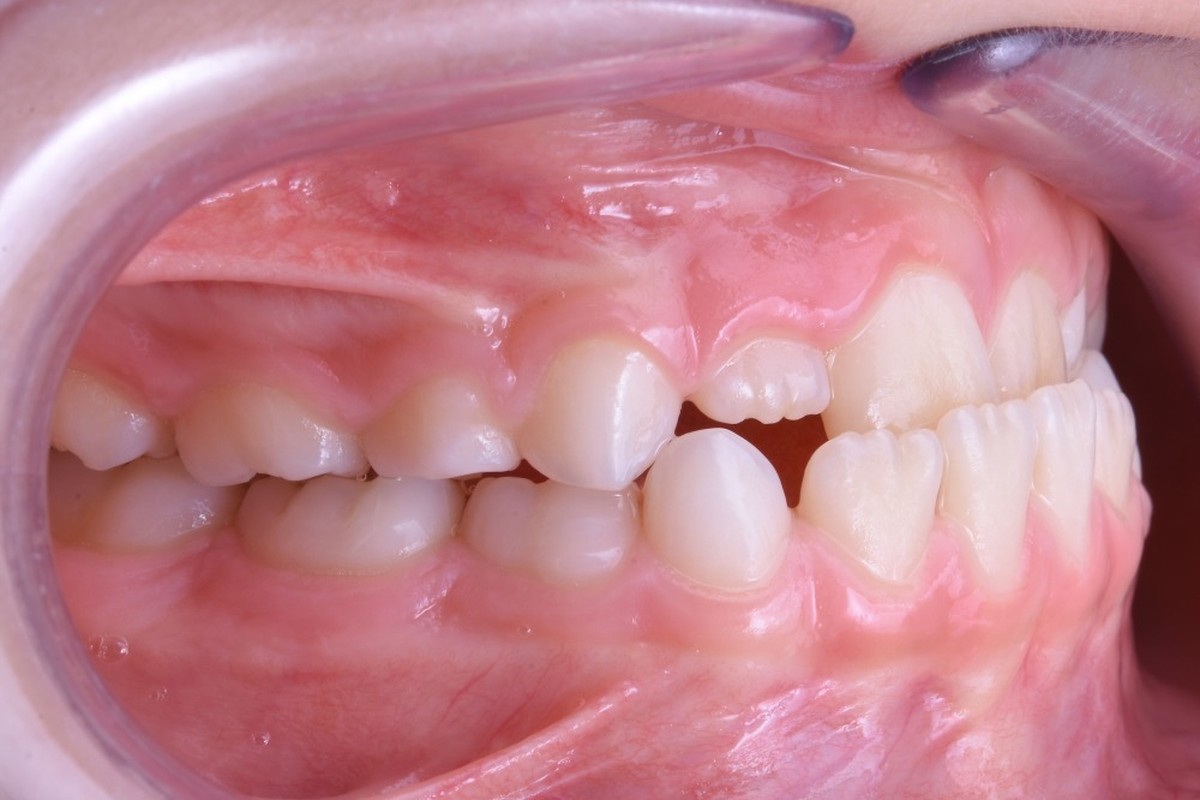 Vista laterale dei denti di un bambino con III classe scheletrica