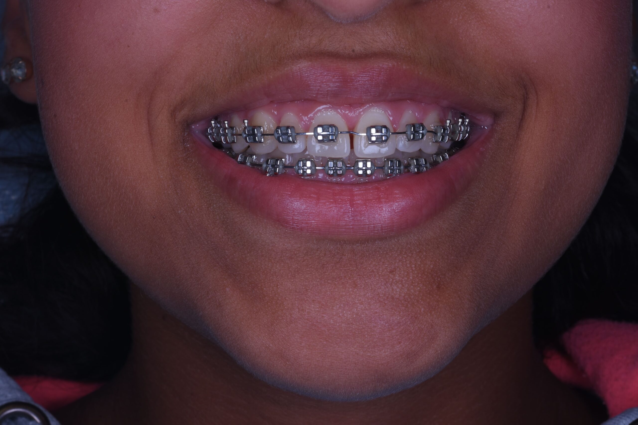 Ortodonzia denti storti | Dentista Santarcangelo - Omnia