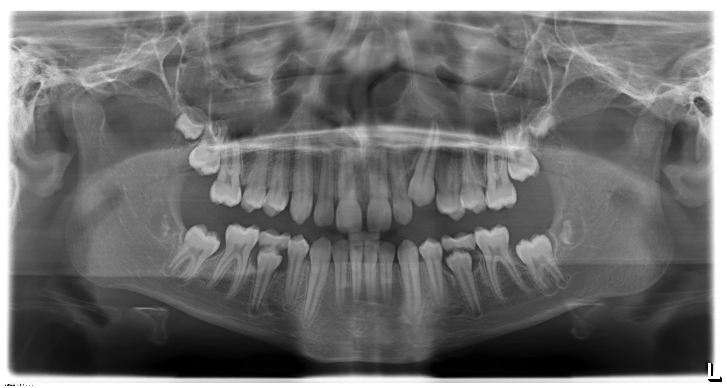 Canino incluso, caso 6-9 anni con estrazione del canino da latte: panoramica di controllo - Omnia Centro Odontoiatrico Santarcangelo