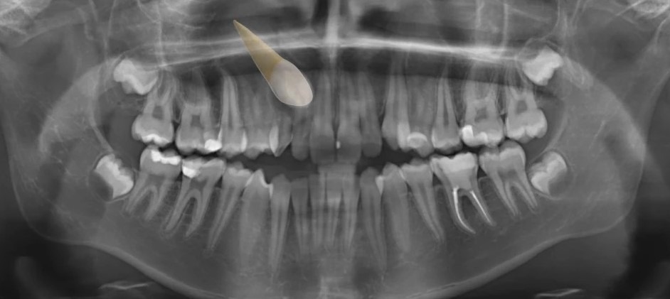 Canino incluso: il dente che resta nascosto e che il tempo trasforma in uno dei casi ortodontici più complessi