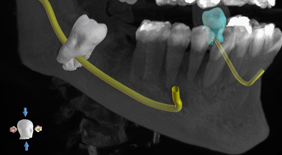 Hai sofferto per togliere i denti del giudizio da adulto? C’è un momento preciso in cui tuo figlio può evitarlo