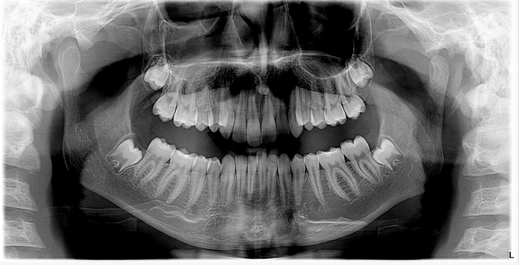 Germectomia dei denti del giudizio: radiografia panoramica di un paziente di 15 anni con i quattro denti del giudizio in forma di germe, corona formata e radice non ancora sviluppata