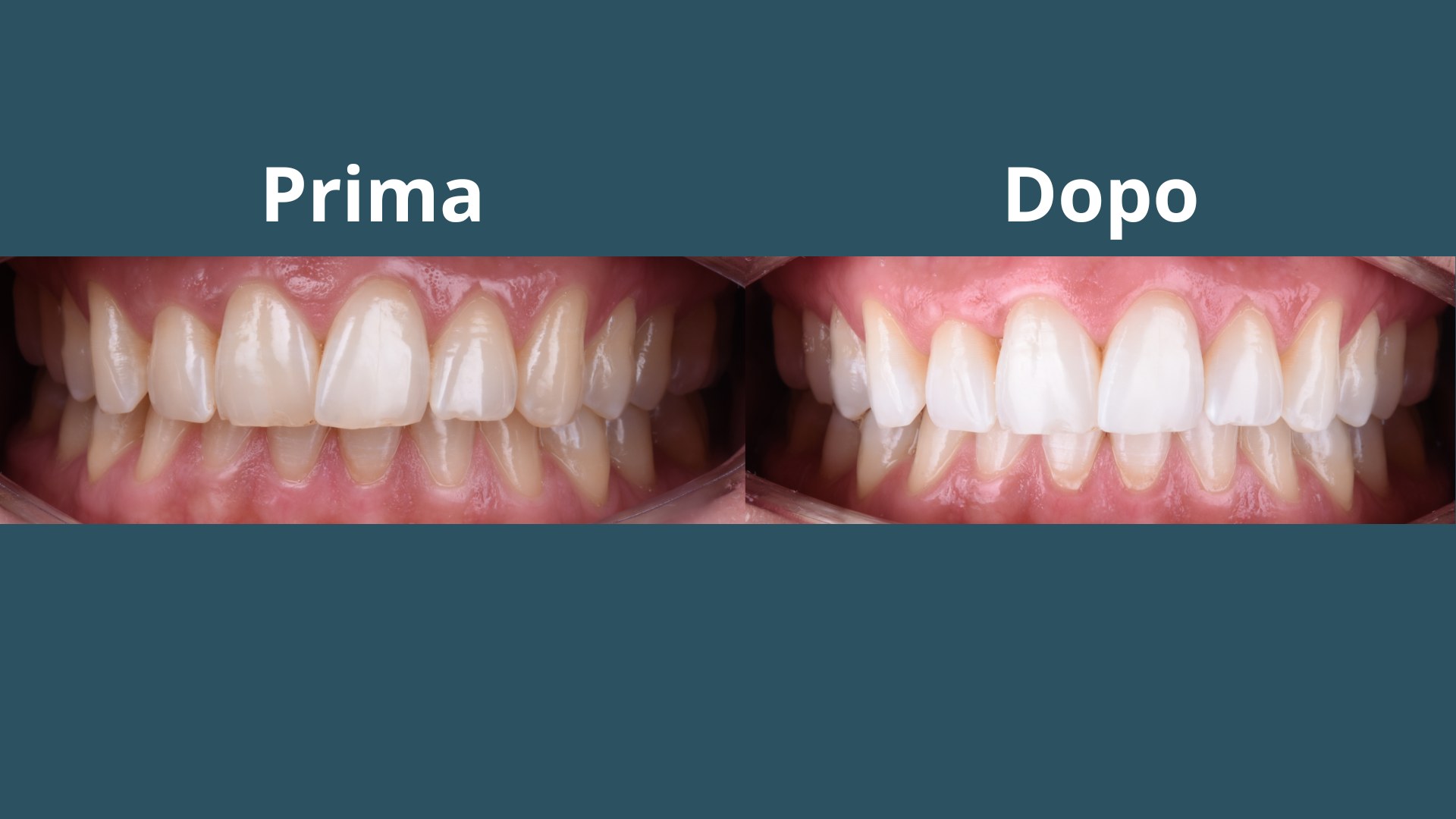 Sbiancamento dentale domiciliare: come farlo in sicurezza