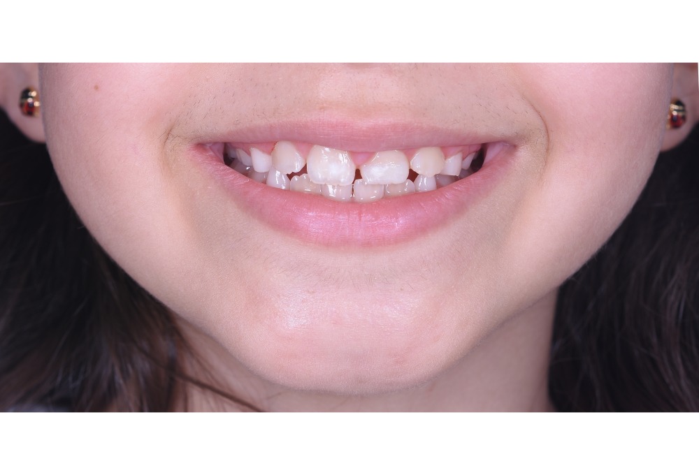 Sorriso di una bambina, Omnia Centro Odontoiatrico a Santarcangelo di Romagna
