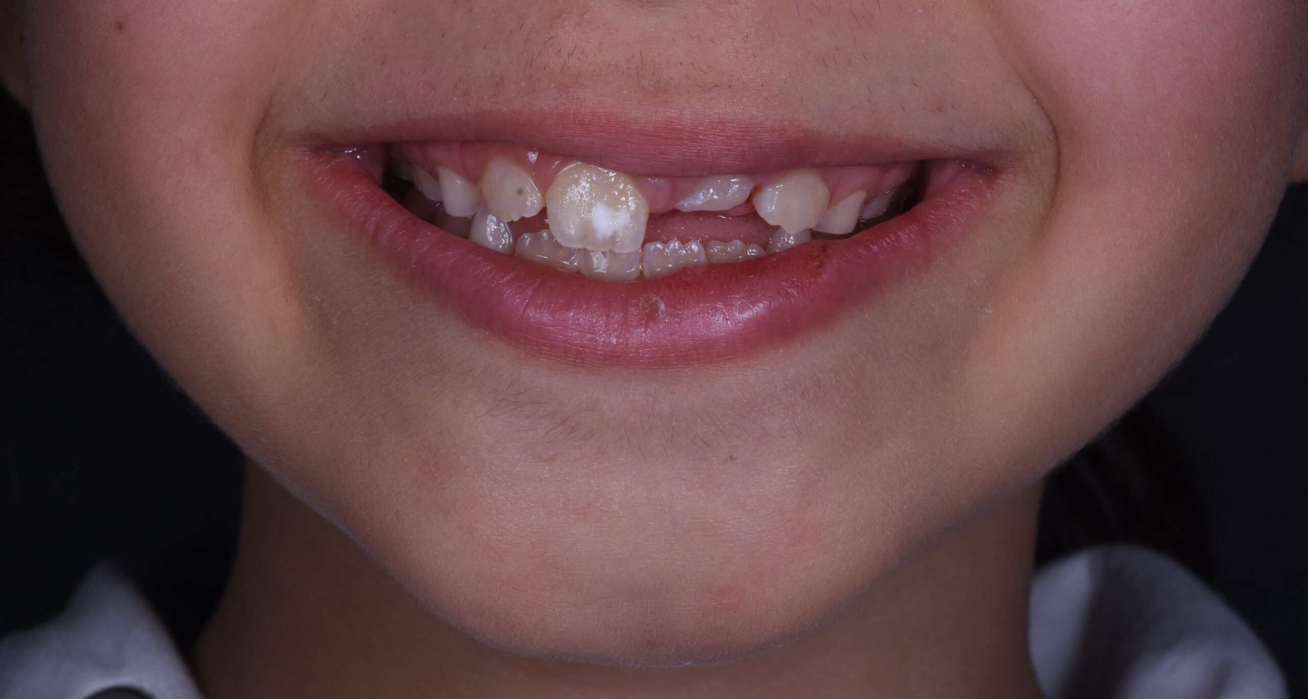 Trauma ai denti: cosa fare se è da latte o permanente